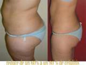 mirna Anuncios gratis en Las Condes |  Baja talla en 12 sesiones y tan solo a $60000, SI cancelas 1 paquete reductivo te obsequiamos 1 masaje express
